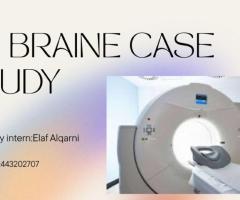 CT Brain case study